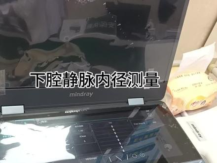 #急诊彩超
下腔静脉内径测量