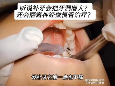 后悔补牙 我牙疼😭#牙疼不是病疼起来要命 #后悔补牙