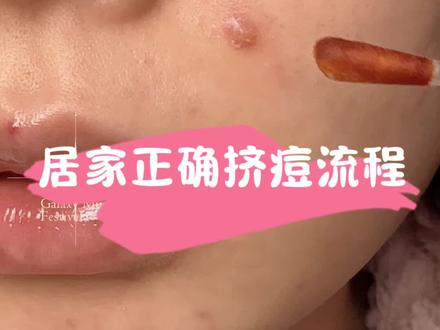 #内容过于真实 #挤痘痘 #痘痘 #痘痘黑头粉刺拜拜 #痘印