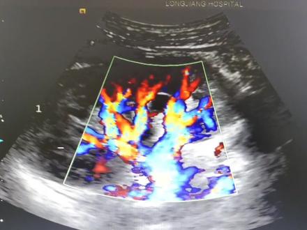 肾动脉的测量方法#医学科普 #超声影像 #健康科普