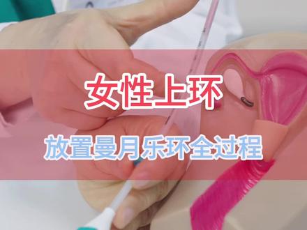 女性上环,放置曼月乐环全过程~#节育环