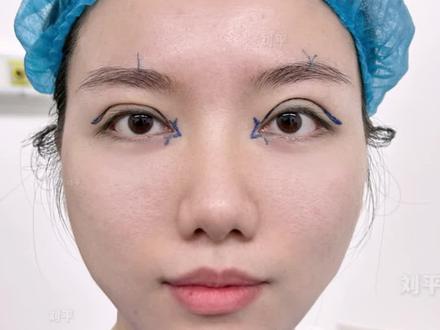 双眼皮修复宽改窄 眼尾下垂提升「全」 #双眼皮修复 #双眼皮修复宽改窄 #眼尾下垂 #内眼角回包 #刘平眼修复