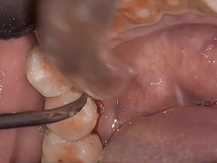 #蛀牙 #洗牙 #牙齿 #牙 #隐适美 五十年老烟王去洗牙,全过程超级解压