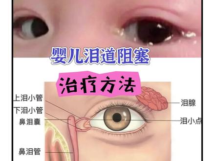 婴儿泪道阻塞的治疗方法