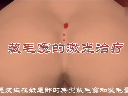 藏毛窦的激光治疗 @DOU+小助手 @郑州市第一人民医院 @抖音健康 @抖音小助手 @抖音热点 @抖音创作者中心 @郑州大学第一附属医院 @河南省人民医院