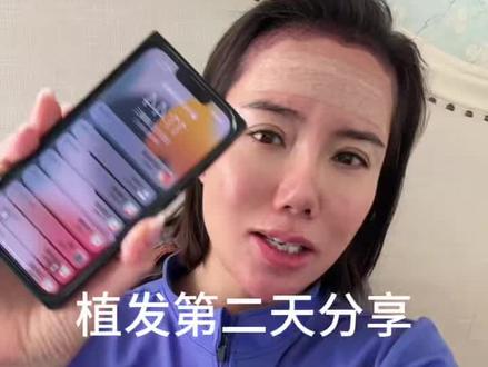 植发第二天真实反馈:没想象中疼,状态ok。
为了更好的自己,值得。#植发术后反馈