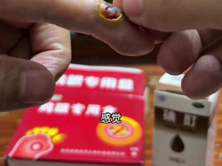 HPV感染寻常疣 网友推荐鸡眼贴和碘酊效果如何?#dou #HPV #寻常疣 #鸡眼贴 #皮肤