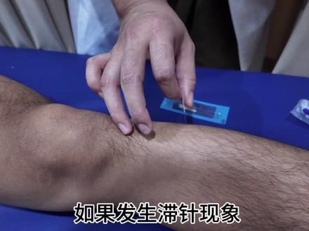 针灸取针 老师叫你取针,你怎么取针