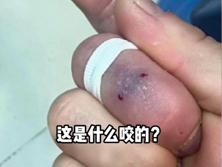 这些都是什么咬的?一条视频带你分清处理!#虫咬皮炎 #蚊虫叮咬 #痒 #医学科普 #抖出健康知识宝藏