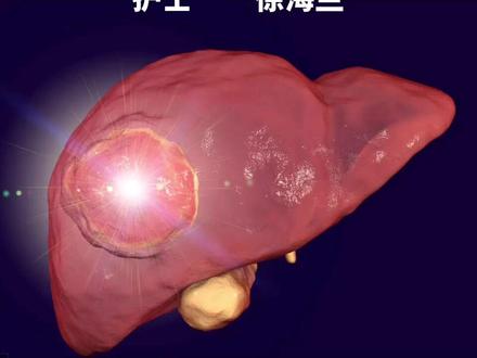 腹腔镜肝脏血管瘤剥离术#肝血管瘤