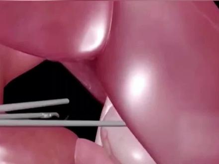 腹腔镜下,胆结石清除过程3D动画演示#医学科普 #胆结石 #湖北胆石中心