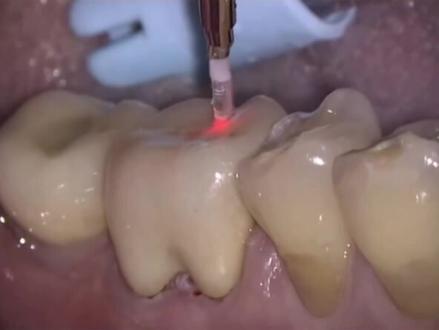 做了全瓷牙,如果基牙出现问题可以把牙冠拆除,再对基牙进行治疗#口腔科刘博闻 @抖音小助手