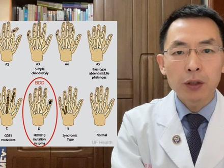 什么是D型短指症?🌹 #D型短指 #短指症 #短指甲 #短粗拇指 #医学科普