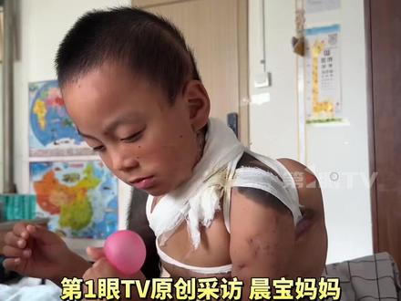 脸上、胸前、后背……#6岁男孩患兽皮痣全身到处埋扩张器 ,晨宝妈妈:我们一家人从黑龙江来到北京治病,为了把他身上的黑色皮肤换掉,目前做了17次手术,花费了100多万。(来源:@小晨宇成长记(逆袭中) )