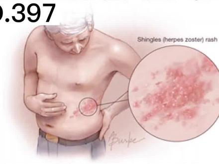 蛇缠腰 很多人犯的四个错误 #带状疱疹#蛇缠腰#注意事项