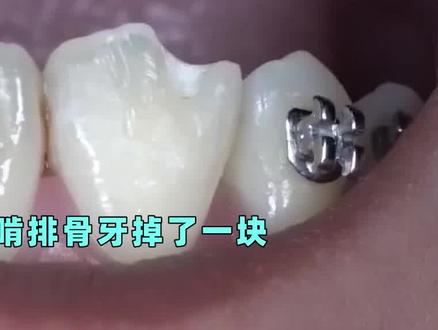 #牙齿 如果不小心缺了一块,可以#补牙 修复#牙齿矫正