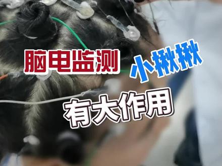 带你了解#脑电监测 ,脑电监测原来是这样做的,并非所有患者都要#剃头发 !#医学科普 #烧脑
