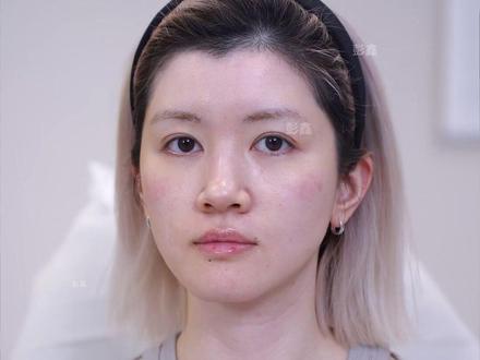 个人效果差异,出镜人已签署相关肖像授权,词讼不宣导任何风险医疗项目!#凹面脸 #上海注射医生 #注射鼻 #月亮脸 #颌面