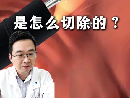 肠镜发现息肉,是怎么切除的? #肠镜 #3D #肠癌 #抖出健康知识宝藏#关于肿瘤的那些事儿