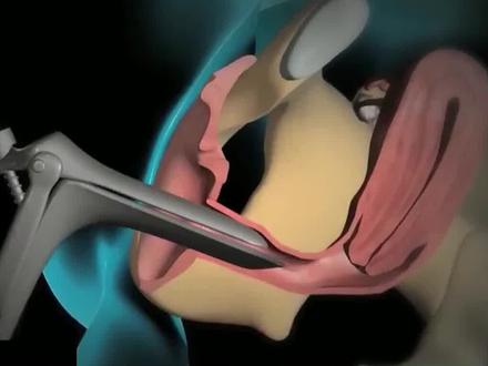 男人无法体会的痛,为伟大女性点赞#宫腔镜 #医学科普 #女性健康