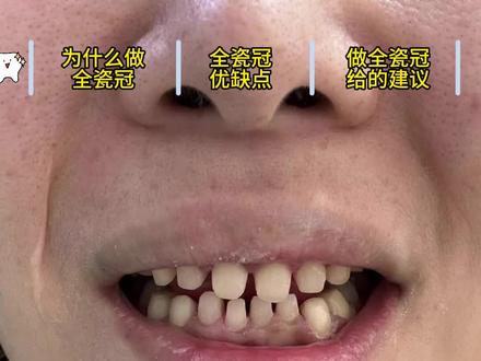 姐妹们我做牙啦!! #全瓷冠 #美牙 #日常唠嗑 #变美小技巧