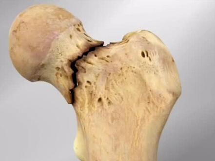 股骨颈骨折微创治疗术 #股骨颈骨折 #股骨颈骨折三根钉 #股骨颈骨折康复之路 #股骨颈骨折康复日记 #股骨颈