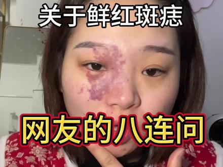 #鲜红斑痣 私信一一解答 点赞收藏做参考哦姊妹们
