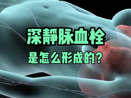 医学科普,3D动画演示,深静脉血栓是怎么形成的?#深静脉血栓形成 #深静脉血栓 #血管外科 #医学科普