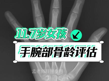 11.7岁女孩骨龄片评估/05标准法/人工解读/预测身高#身高 #骨龄片 #看骨龄