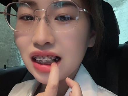 戴牙套第11天| 没有吃硬的东西 不知道咋回事托槽就掉了🥹#牙套 #经验分享 #牙齿 #正畸 #牙齿矫正