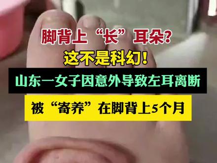 (原创)脚背上“长”耳朵?这不是科幻!山东一女子因意外导致左耳离断,被“寄养”在脚背上5个月