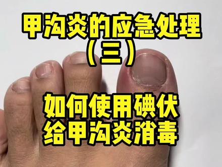 如何使用碘伏给甲沟炎消毒,你知道吗?
友情提示:有空了,还是要去看医生哦#脚趾甲 #脚指甲往肉里长怎么办 #医学科普 #甲病