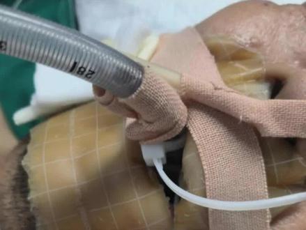 气管插管好,还是气管切开好啊?#气管插管#气管切开 #宣传急重症防治常识 #普及心脏按压 #分享干货知识