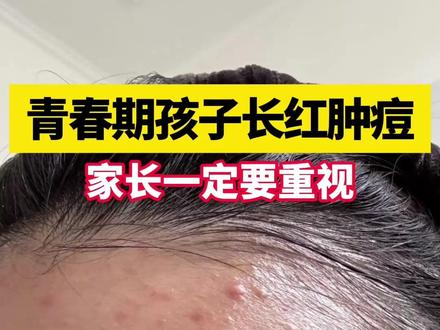 青春期孩子爱长痘,家长千万要重视,别等留下痘坑痘印再后悔,医生一条视频教你处理#红肿痘 #痤疮 #青春痘 #皮肤 #抖出健康知识宝藏
