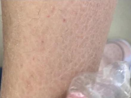 腿上皮肤干痒像鱼鳞,有可能是#鱼鳞病 鱼鳞病!#皮肤管理 #健康科普