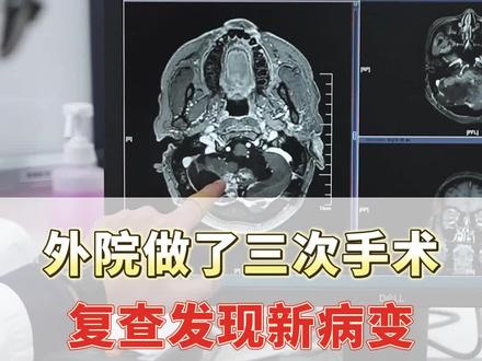 外院做了三次手术,复查发现新病变#开启健康2023 #医学科普
