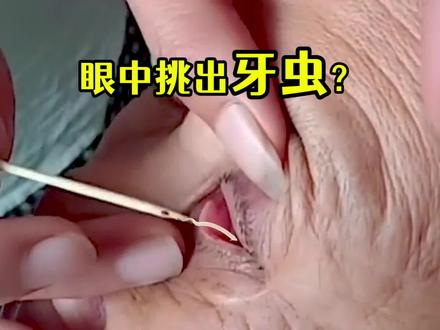 根治牙痛?揭秘民间:眼中挑牙虫和熏牙虫骗术,很多人已报警 #揭秘 #骗术 #牙虫 #违法 #骗局