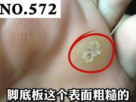 脚底长硬疙瘩,走起路来有点痛,教你一个方法,自己在家也能用#医学科普 #跖疣