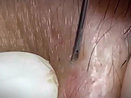 宝汁萌这期格外的饱满#护肤 #痘痘黑头粉刺拜拜#细胞夹面部清理工具 #深层毛孔清洁#解压