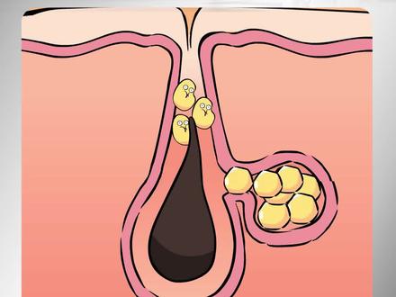 快把我推给有痘痘困扰的朋友!长期长痘一定要知道的祛痘攻略!