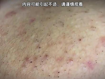 铁汁们这期真的太饱满了#解压挤痘痘 #强迫症治愈系 #痘痘黑头粉刺拜拜 #黑头清理 #解压