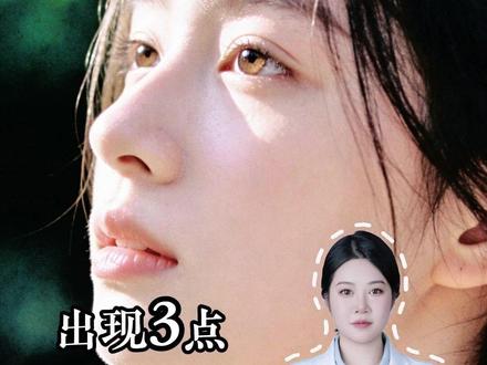 埋线双眼皮失败三种典型表现 #埋线双眼皮效果 #眼修复 #成都双眼皮 #何莎医生