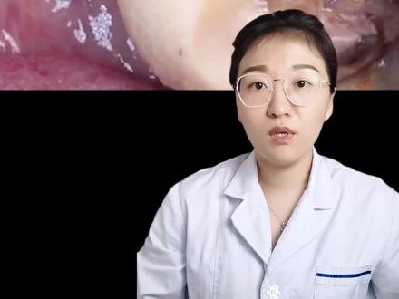 洗牙天花板,超级严重的牙结石!#洗牙 #口腔健康 #爱护牙齿 #清洁 #牙 #健康