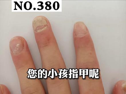 上周日,门诊遇到的一个男孩,仅仅三个月,只有一个手的指甲是好的,其他都被感染了#灰指甲 #科普 #皮肤
