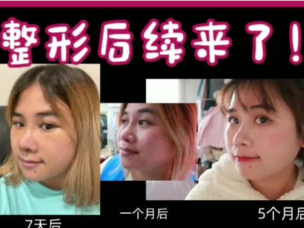 韩国鼻子整形结束之后花花的心得 #韩国整形 #鼻子整形 #韩国留学 #韩国留学生