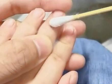 手上长了黄豆大小的硬疙瘩,这样处理是比较快的#健康 #科普#好东西一起分享