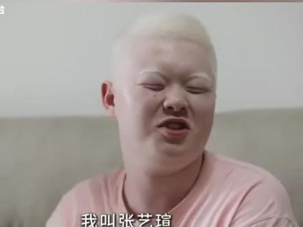 好样的!山东男孩高考688分被清华录取,因患白化病得用望远镜看黑板#山东菏泽白化病男孩考入清华