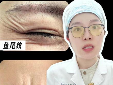 初次打除皱,必看注意事项来啦! ⚠️打完除皱会出现:飞眉?压眉?双眼皮变窄?两边不对称?
打除皱之前一定要进行术前评估,第一次打的时候一定要小心
🌟每个人的体质都不同,书上面的剂量不见得适合每一个人,所以除皱最好找一个医生长期打,这样医生会经过多次注射后,找到一个适合你的剂量✅
除皱其实不会很疼的~
#眼周抗衰 #面部抗衰 #眼周年轻化 #注射 #八大处郭小双