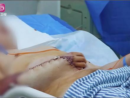 男子意外烧伤进行腹部皮瓣移植手术,保住了一条手臂!把手埋进肚子里到底是什么神操作?!#我的白大褂 #烧伤 #手术 #科普