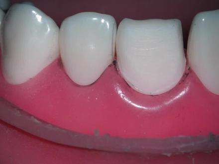 口腔排龈线使用的方法和操作 #全瓷牙 #瓷贴面 #牙齿健康 #排龈线 #使用的方法 #口腔排龈线 #口腔